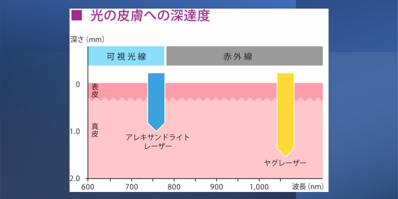 2種類のレーザーで幅広い脱毛治療に対応